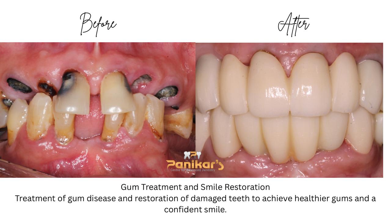 Veneers Case