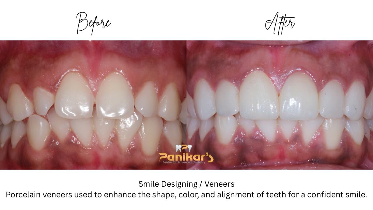 Dental Veneers